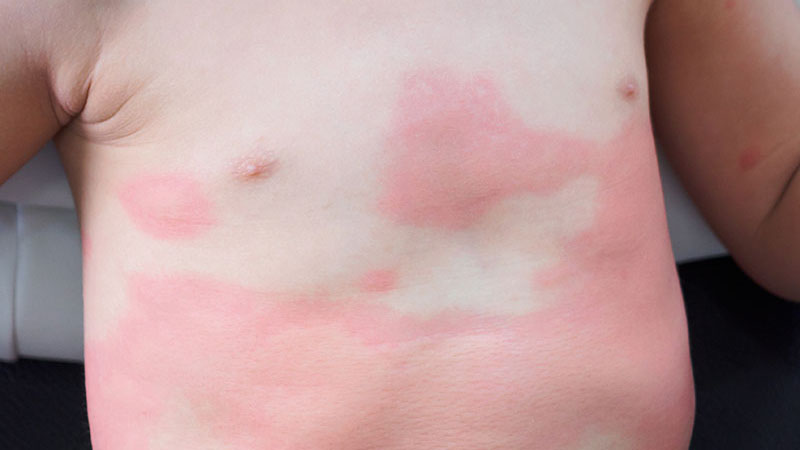 Children chest with evident urticaria spots