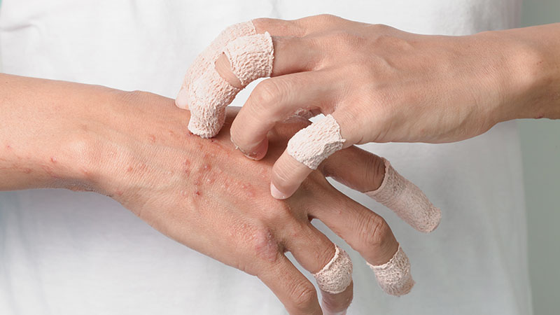 Scratching hand with evident urticaria symptoms