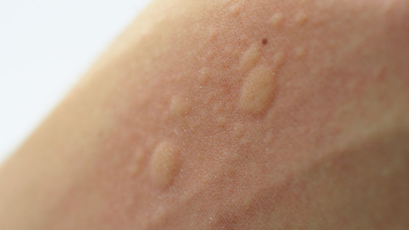 Skin with urticaria, close-up
